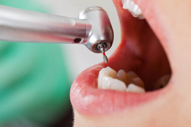 Best Emergency Dentist for Knocked-Out Tooth in Dickson, OK